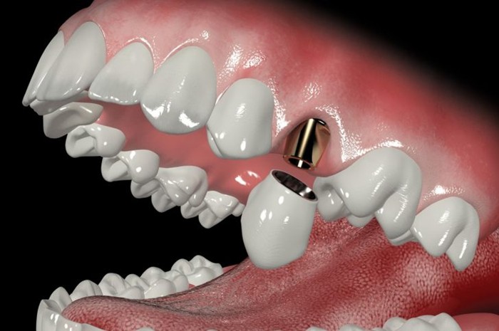 Что такое абатмент в имплантации зубов